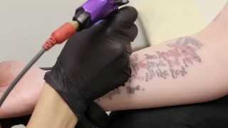 Nonlaser Tattoo Removal [upl. by Nelleh]