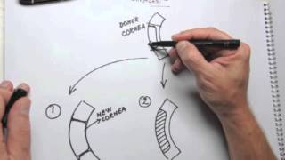 Sketch  Corneal transplant types [upl. by Enelrae496]