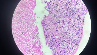 Bilateral TB Pleurisy with Adenitis  The Tale of two most common Extra Pulmonary TB [upl. by Ayn]