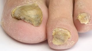 Considering a Laser Treatment For Toenail Fungus Watch This Video FIRST [upl. by Tullus]