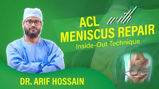 Meniscus repair insideout technique ।। মিনিসকাস রিপেয়ার ইনসাইডআউট টেকনিক [upl. by Lauren351]