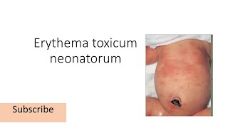 Erythema toxicum neonatorum [upl. by Fedora]