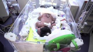 Newborn Baby with Spina Bifida Undergoes Multiple Surgeries [upl. by Gerius779]