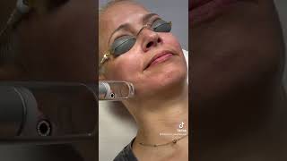 Laser treatment for melasma [upl. by Orhtej]