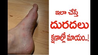 How To Get Rid Of Eczema Psoriasis Itching At Home [upl. by Aliber]