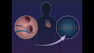 Catheter Ablation for Advanced Heart Failure and AFib  NEJM [upl. by Rickey]