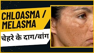 चेहरे के दाग क्यू होते है  वांग  chloasma  melasma beautycare  female skin problem skincare [upl. by Annaillil699]