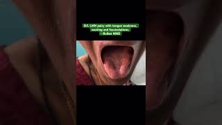 Bulbar Motor Neuron disease BL LMN palsy  tongue weakness wasting amp fasciculations neurology [upl. by Oretos749]