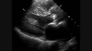 Calcific Aortic Stenosis  Echocardiogram [upl. by Emerick]