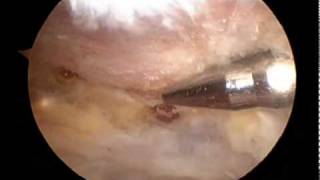 Arthroscopic subacromial decompression  Dr Terry Hammonddv [upl. by Ihpen]