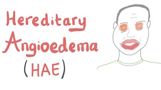 Hereditary Angioedema HAE [upl. by Ojytteb]