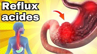 Ne mange pas ces aliments avec le REFLUX ACIDE [upl. by Enila]