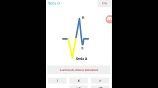 ECG CALC Sgarbossa Criteria MI with LBBB [upl. by Gasser]