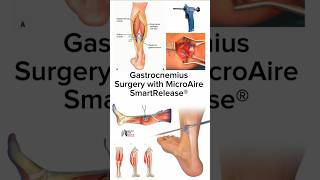 Gastrocnemius Surgery with MicroAire SmartRelease® medical animation 3d short [upl. by Ignacia]