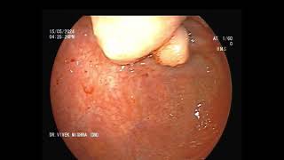 कोलोनोस्कोपी करने पर मिला बड़ी आंत में गांठ  Colonic polypoidal lesion at cecum  GASTROLIVER [upl. by Ahsinaj]