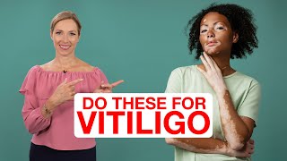 7 TIPS to Help VITILIGO  Dr Janine [upl. by Ainoek309]