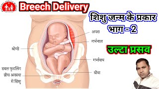 Breech Delivery। उल्टा प्रसव। प्रसव के प्रकार। [upl. by Dinsmore]