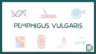 Pemphigus Vulgaris Oral Cavity Symptoms and Treatment [upl. by Reyna]