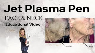 Jet Plasma Pen Face amp Neck Skin Tightening [upl. by Ellebasi]