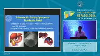 Curso Endoscopía  Intervención endoscópica en trombosis portal [upl. by Hamer]