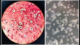 Cryptococcus neoformans Meningoencephalitis [upl. by Obie]