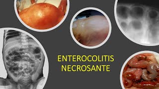 Enterocolitis necrosante [upl. by Eanom]