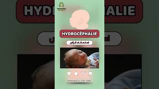 HYDROCÉPHALIE  استسقاء الرأس [upl. by Michaud96]