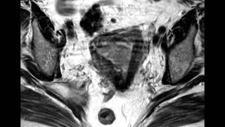 Endometrial Cancer with 50 myometrial invasion [upl. by Assile]