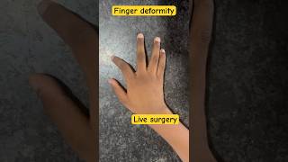 Finger tedha ho jaye toh kya kare  finger bone healing drsanjeevortho fingerinjury [upl. by Oinegue]