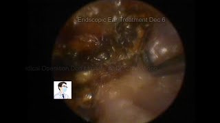 Postoperative cleaning of cholesteatoma of middle ear20221206 [upl. by Bunder]