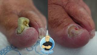 TRIMMING A quotTHICCquot TOENAIL  AMAZING BEFORE AND AFTER [upl. by Meter323]