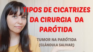 Tipos de cicatrizes da cirurgia da parótida glândula salivar [upl. by Demetri]