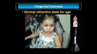 Congenital Esotropia [upl. by Avert276]