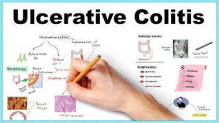 Ulcerative Colitis Clinical features morphology diagnosis treatment [upl. by Sert215]