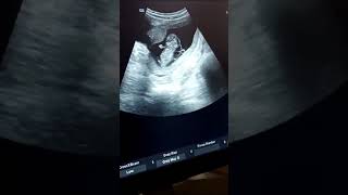 Cystic hygroma in 10week pregnancy [upl. by Formenti]