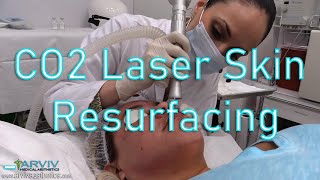 Fractionated CO2 Laser Skin Resurfacing by ArvivAestheticscom [upl. by Crichton]