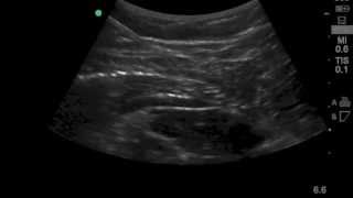 Case of the Week Quadratus Lumborum QL Catheter [upl. by Annayram]