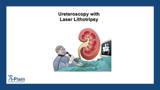 Ureteroscopy with Laser Lithotripsy [upl. by Hagai]