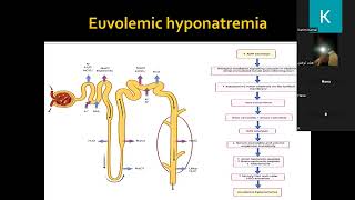 Chronic hyponatremia Dr Kareem Kamal [upl. by Marquardt]