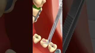 ASMR teeth  Cleaning cavity asmr treatment asmr teeth satisfying india [upl. by Monroe]