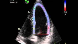 IS EJECTION FRACTION NORMAL 2  STRAIN VALUE  ECHOCARDIOGRAPHY cardiac ultrasound [upl. by Carthy]