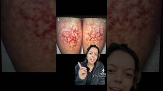 Erythema Ab Igne Beware skincare dermatology spaceheaters [upl. by Sleinad]