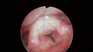 Laryngopharyngeal Reflux and Anterior Glottic Pinch [upl. by Palla840]