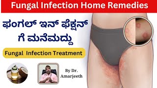 Fungal Infection  ಗಜಕರ್ಣ Ringworm Treatment in Kannada  ಹುಳುಕಡ್ಡಿಗೆ ಮನೆಮದ್ದು  By Dr Amarjeeth [upl. by Januisz291]