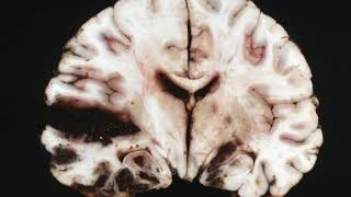 Difference Between Glioma and Glioblastoma [upl. by Ocker]