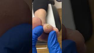 Unleash the secrets of toe callus removal by a podiatrist Your feet deserve the best [upl. by Mathews]