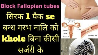 fellopian tube blockage in hindi  fellopian tube blockage treatment heenhaealth [upl. by Aundrea]