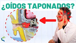 ¿OÍDOS TAPONADOS 🙉 Remedio natural para eliminar el tapón👂 [upl. by Froh]