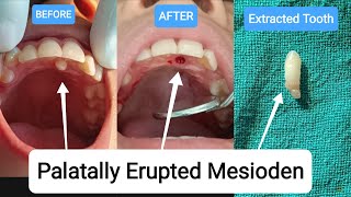 🇳🇵Extraction of Supernumerary Tooth Mesiodens Extra Tooth Exodontia Palatally Erupted nepal [upl. by Amary572]