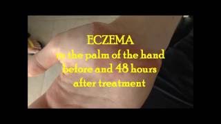 Hand Eczema before and 48 hours after treatment [upl. by Nyleahs]